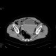 Bleeding into urinary bladder: CT - Computed tomography